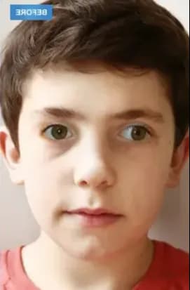 Digital Therapy for Intermittent Strabismus