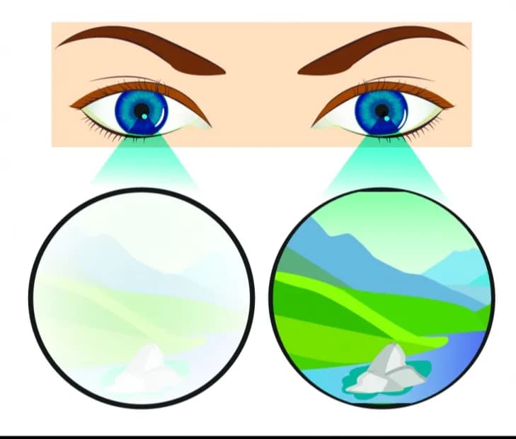 Let's Understand Lazy Eye(Amblyopia)